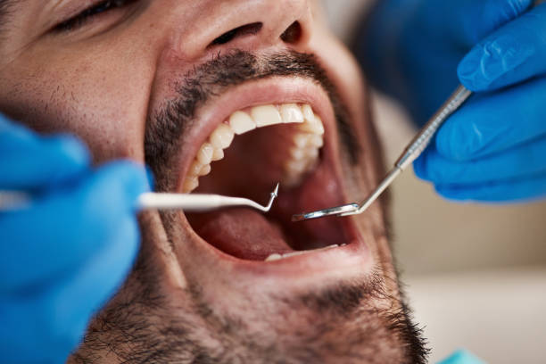 Best Emergency Wisdom Tooth Extraction in Timberlake, VA