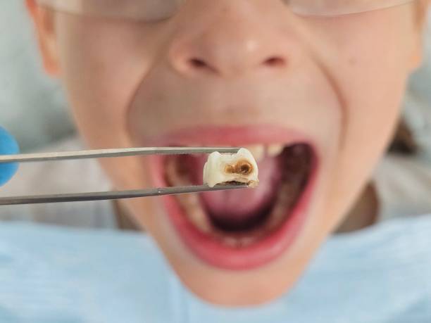 Best Knocked-Out Tooth (Avulsed Tooth) Treatment in Timberlake, VA